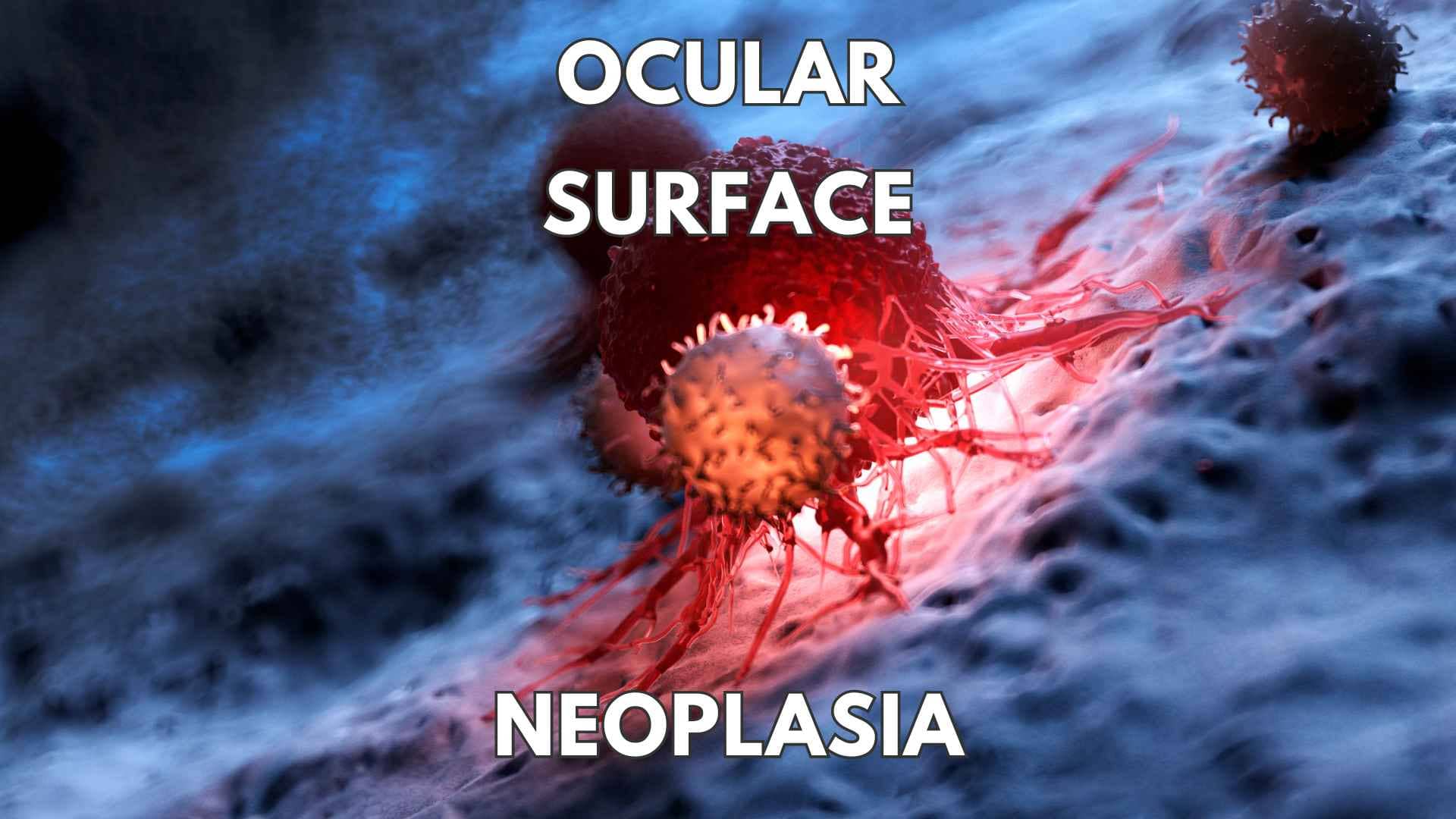 Ocular surface neoplasia - Dr Anthony Maloof