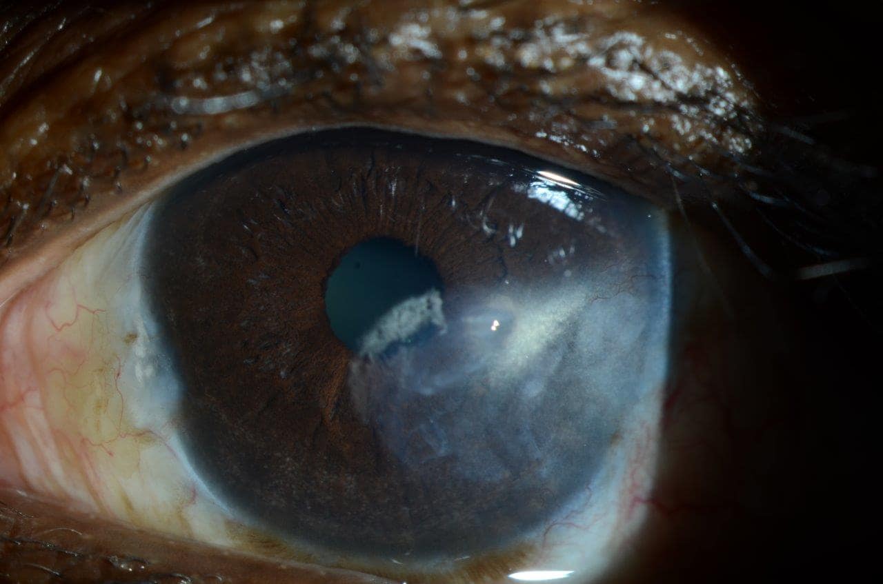 Pterygium Scar Corneal Surgery